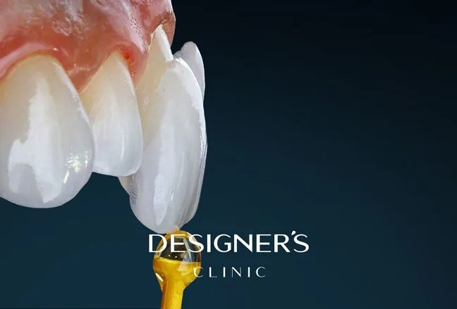 تصميم عدسات E.Max في مختبر Designer's Lab